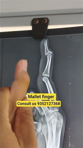 mallet finger deformity #stiffness #physiotherapy #splint #plaster #finger #joint #hand #wrist #ruhs
