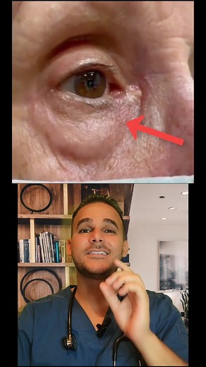 Mioquimia: Causas y Soluciones para Fasciculaciones Oculares