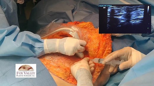 Ultrasound Guided TAP Block (GRAPHIC)
