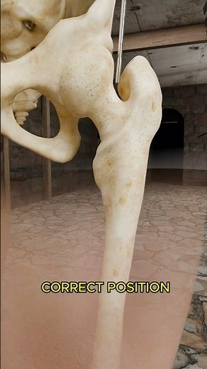 How A Compound Fracture Is Treated🤔