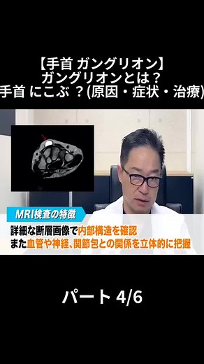 手首のガングリオンについて徹底解説
