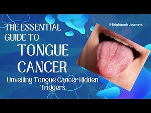 The Essential Guide to Tongue Cancer: Unveiling Tongue Cancer Hidden Triggers