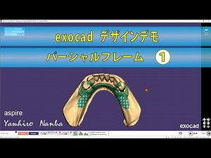 exocad partial denture design training パーシャルデンチャートレーニング