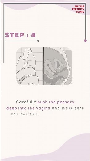 Vaginal Pessary : How to insert it during fertility treatment. #ivfjourney #ivfspecialist #fertility