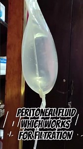 Peritoneal Dialysis CAPD At Home 😀😄🙂 #capd #peritonealdialysis