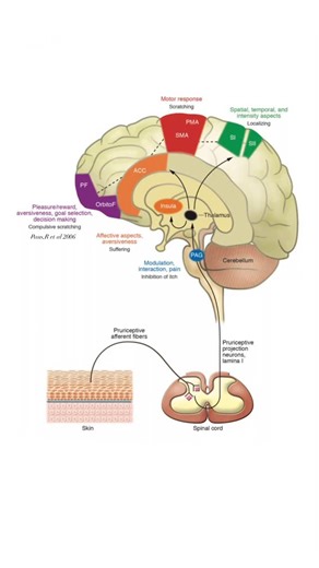 @biochemistry_nutrition_medlab on Instagram‎: "Central processing of pruritus.🧠Itching(pruritus)is perhaps the most common symptom associated with numerous skin diseases& can be a lead symptom of extracutaneous disease(e.g.,malignancy,infection,& metabolic disorders).Pruriceptive primary afferent nerve fibers from the skin activate spinal neurons in lamina I of the dorsal horn,which project to the thalamus.Direct excitatory connections from the thalamus include anterior cingulate cortex(ACC),in