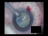 Cataract Surgery • Video • MEDtube.net