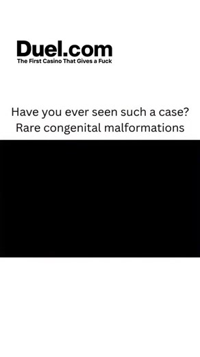 what if on Instagram: "Yes, such cases have been documented. A human tail is a rare congenital malformation where a skin-covered appendage protrudes from the limbo sacral region, considered an embryonic remnant that can be a true or false (pseudo) tail. These are rare, with over 100 cases reported in the literature, and can be associated with underlying neurological issues like spinal dysraphism and tethered cord syndrome. What is a human tail? It’s a rare birth defect in humans, a midline cutan