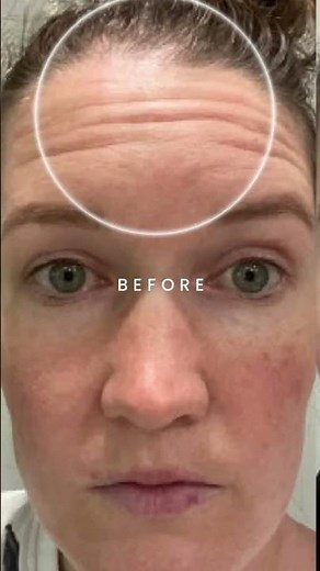 Using A FasciaBlaster On Your Face - Before & After