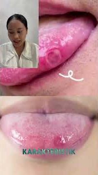 "Stomatitis : Pengertian dan Ciri Klinis"