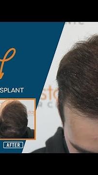 Μεταμόσχευση μαλλιών: στάδιο 4 προς 5, FUE, 2500 τριχοθυλάκια | 15 μήνες μετά - Case #267