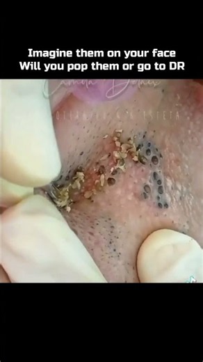 Imagine them on your face, Will you pop them or go to DR