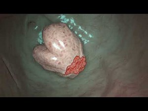 Underwater EMR an effective technique to remove large polyp in colon, Dr Vikas Singla