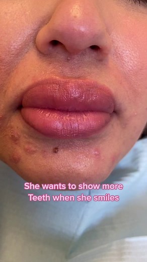 Big lips covering teeth!!!! #smiletransformation #whiteteeth #porcelainveneers #veneers #dentist #cosmeticdentist