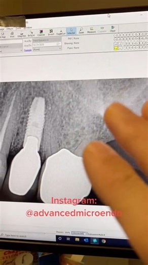 #dentistry #dentalschool #dentists #rootcanaltherapy #hygienist | Advanced Micro-Endodontics