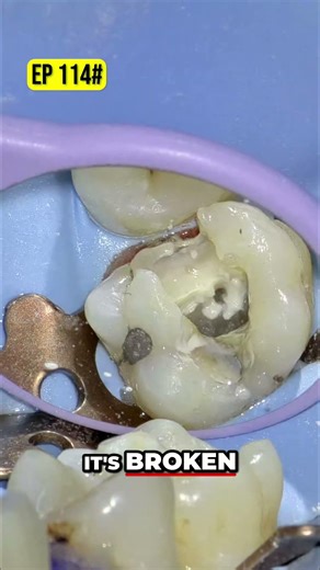 MB2 Negotiation Avoiding File Fractures with GlidePath
