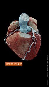 92K views · 921 reactions | High-resolution photon-counting CT scans even for complex cases are redefining how physicians approach cardiac imaging. | Siemens Healthineers | Facebook