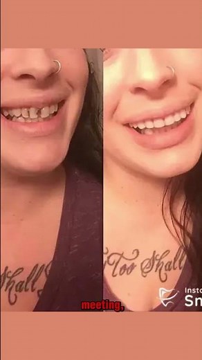 Struggling with Your Smile... Check Instant Smile Teeth Veneers | Perfect Smile Instantly