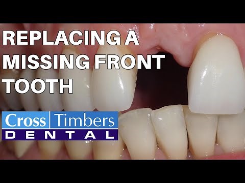 Case of the Week: Replacing a missing front tooth