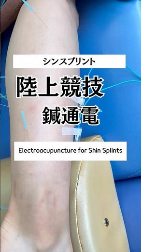 Electric acupuncture for shin splints #Seirin #Picolina #Electric acupuncture