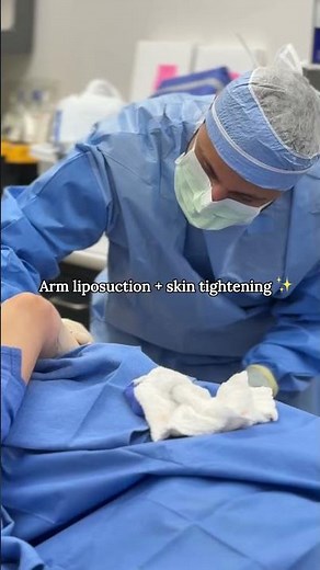 Awake arm liposuction in action 👀
