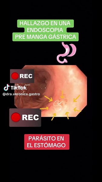 El Anisakis: Riesgos y Hallazgos en el Estómago