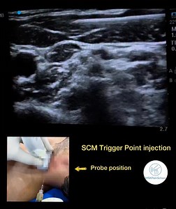 SCM muscle trigger point injection | Wiquar Ahmed