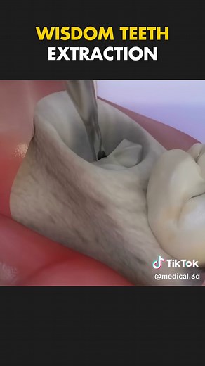 Wisdom Tooth Extraction: The Procedure Explained in 60 Seconds