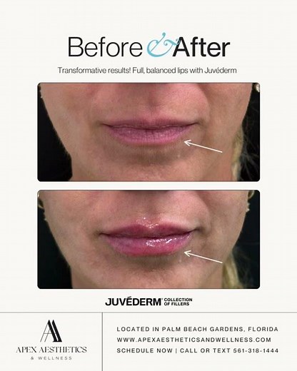 Juvéderm Lips | Before & After