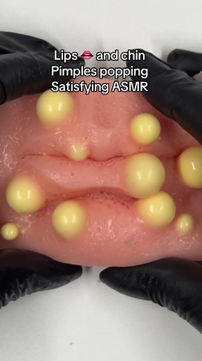 Satisfying Pimple Popping ASMR for Relaxation
