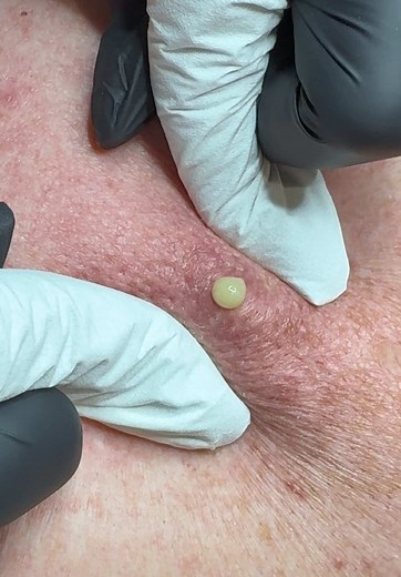 Sebaceous Cyst Removal: Unforgettable Oozing Moment