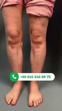 Day 1 After Calf Implants: Immediate Results! #aesthetic
