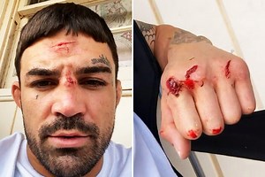UFC star Mike Perry shows off gruesome mystery cuts on head and hands just week before Vegas fight return