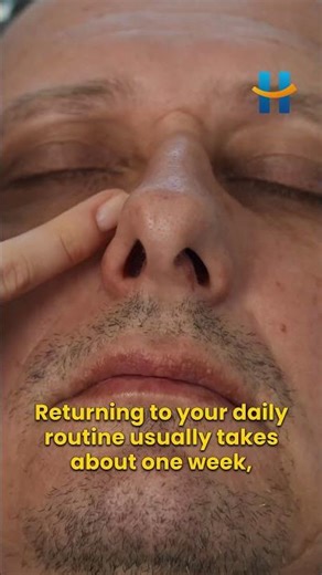 When do the nostrils shrink after rhinoplasty? 👃✨