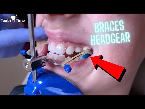 Headgear Braces - Orthodontic Appliance - 11 Year old patient - Tooth Time New Braunfels Texas