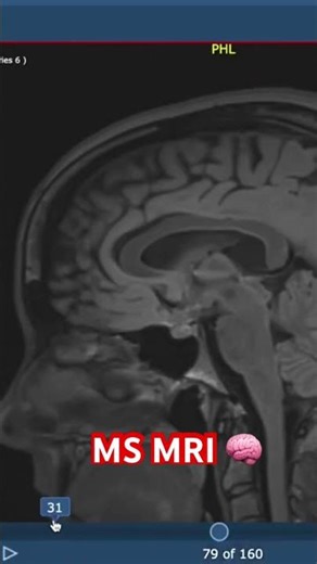 MS MRI 🧠