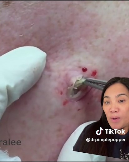 In this new year, it’s the perfect time to review some of the best extractions of all time! Which one of these is your favorite? Who want to see more POPS? #drpimplepopper #dpow #dilatedpore #breakingout. #greenscreenvideo
