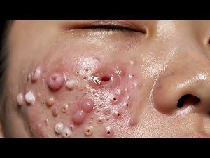 Blackhead Extraction HD | Ultra Close-Up, No Filters