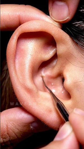 Favorite Watch This Satisfying Pimple ear Removal!