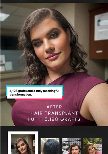 5,198 grafts and a truly meaningful transformation. Our patient is a transgender woman, and our goal was to feminize her hairline — softening its shape, restoring density, and creating a frame that aligns with how she sees herself. Hair restoration can be an incredibly personal part of gender affirmation, and we’re honored she trusted us with this step in her journey. #drvarona #drvaronahairrestoration #hairloss #fuehairtransplant #hairtransplant