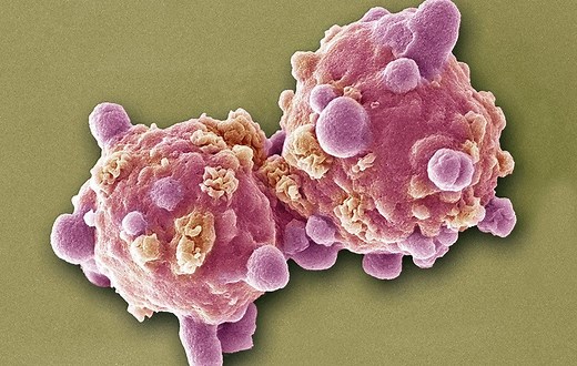 6 Signs Of Leukemia Every Woman Needs To Know