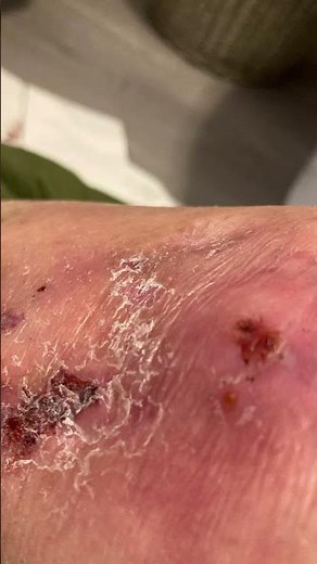 Xylazine & Fentanyl wounds very early stages