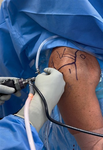 Those are the first steps for a shoulder arthroscopy; a minimally invasive surgical procedure in which a small camera (known as an arthroscope) is inserted through tiny incisions to allow direct visualization of the shoulder joint. Using specialized instruments, we can accurately diagnose and treat a variety of conditions, including rotator cuff tears, labral injuries, and joint inflammation. This approach typically results in less postoperative pain, smaller scars, and a faster recovery compare