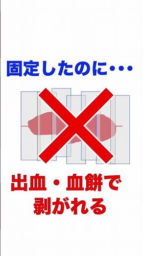 Don't apply sterilization tape too tightly [How to properly apply sterilization tape to wounds] #...