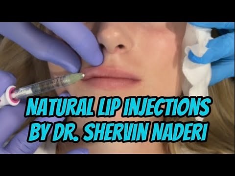 Natural Lip Injections with Juvederm Volbella