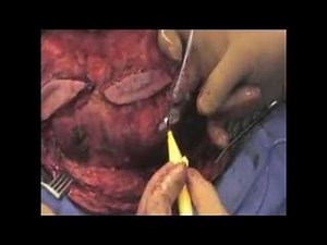 Scapula Amputation - Part 2 • Video • MEDtube.net