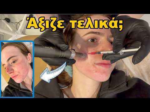 ΔΟΚΙΜΑΣΑ ΜΙΚΡΟΒΕΛΟΝΙΣΜΟ ΝΑ ΞΕΦΟΡΤΩΘΩ ΤΑ ΣΗΜΑΔΙΑ ΑΚΜΗΣ//VLOG 4 ΜΕΡΕΣ