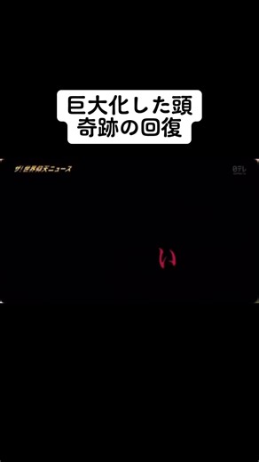 水頭症の奇跡的回復：ルーナの感動ストーリー