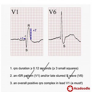 14 reactions | Right Bundle Branch Block - Some Useful Tips. Learn more at https://acadoodle.com #emergencymedicine #intensivecare #respiratory #respiratorycare #icu #nurses #icunurse #ecg #ekg | Acadoodle | Facebook