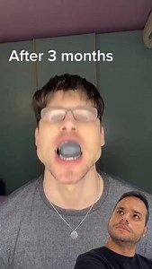 Jaw alignment using a bite corrector | Juliano Manzioli